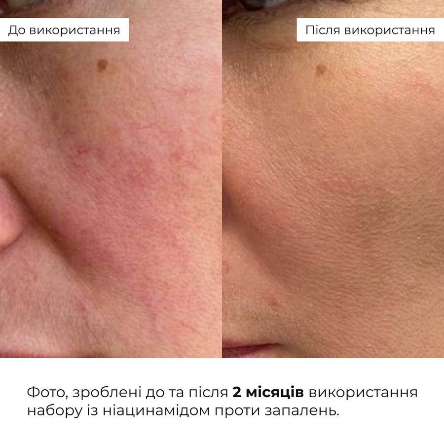 Комплекс для очищення, себорегуляції та захисту шкіри SPF 30 Hillary Cleansing, Oil Control & Skin Protection Complex - фото №1