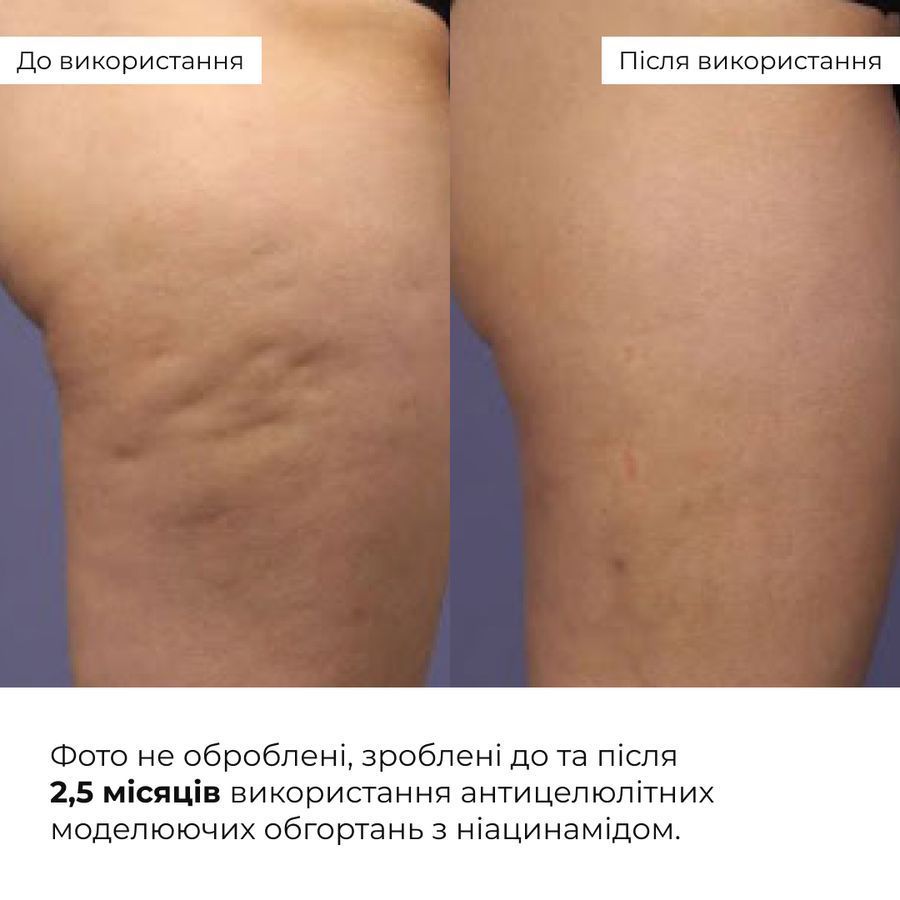 Курс антицелюлітних моделюючих обгортань з Ніацинамідом Hillary Niacinamide Cold Slim (6 уп.) - фото №1