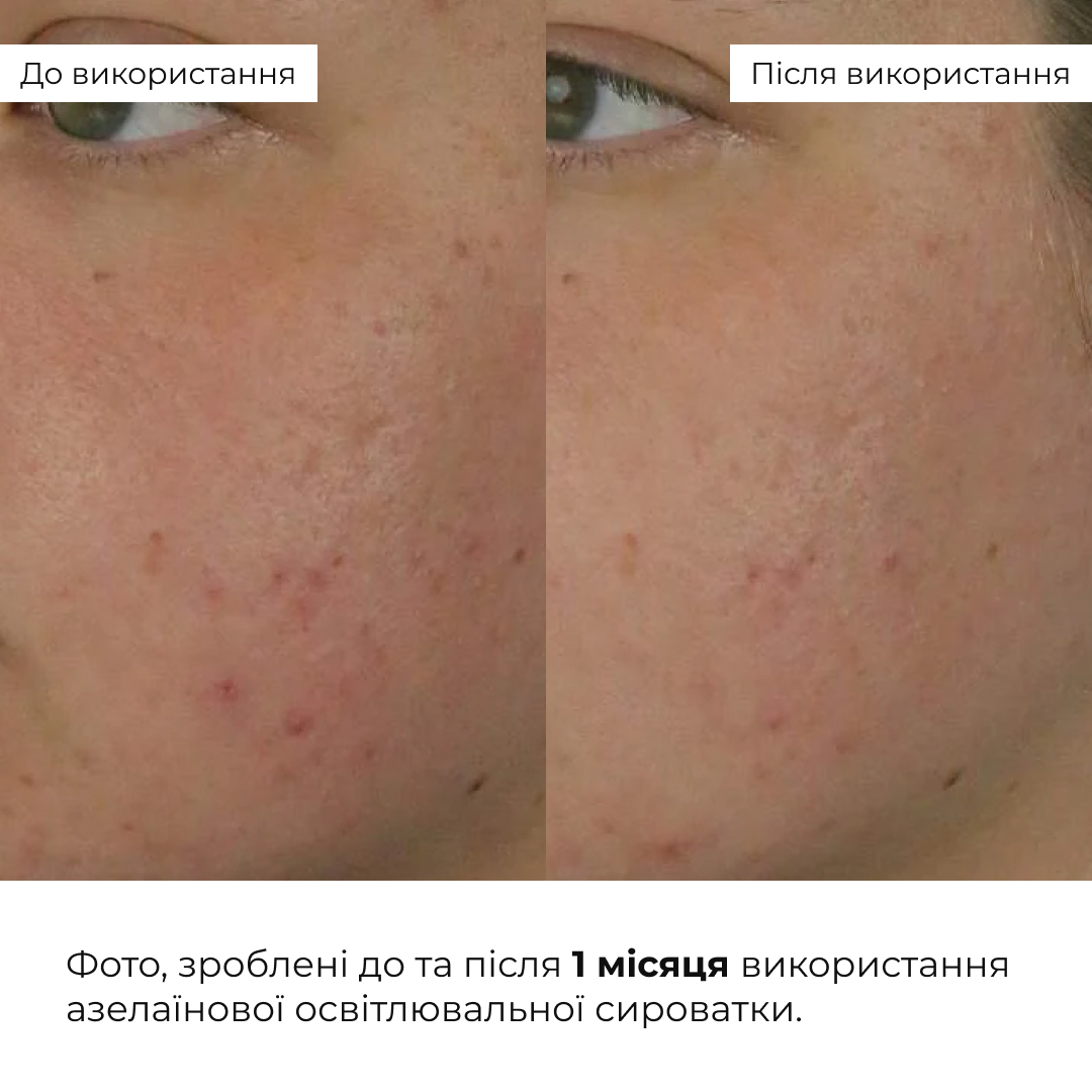 Азелаїнова освітлювальна сироватка Hillary Azelight Defense Serum, 30 мл