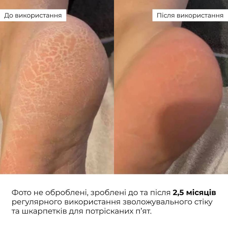 Набір для зволоження та пом'якшення потрісканих п&rsquo;ят Hillary Set for Moisturizing & Softening Cracked Heels - фото №1