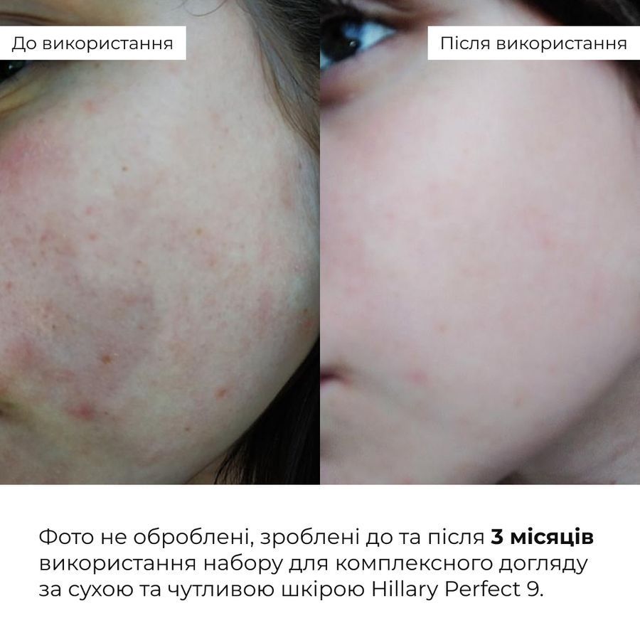 Hillary Perfect 9 Comprehensive Care Kit for Dry and Sensitive Skin