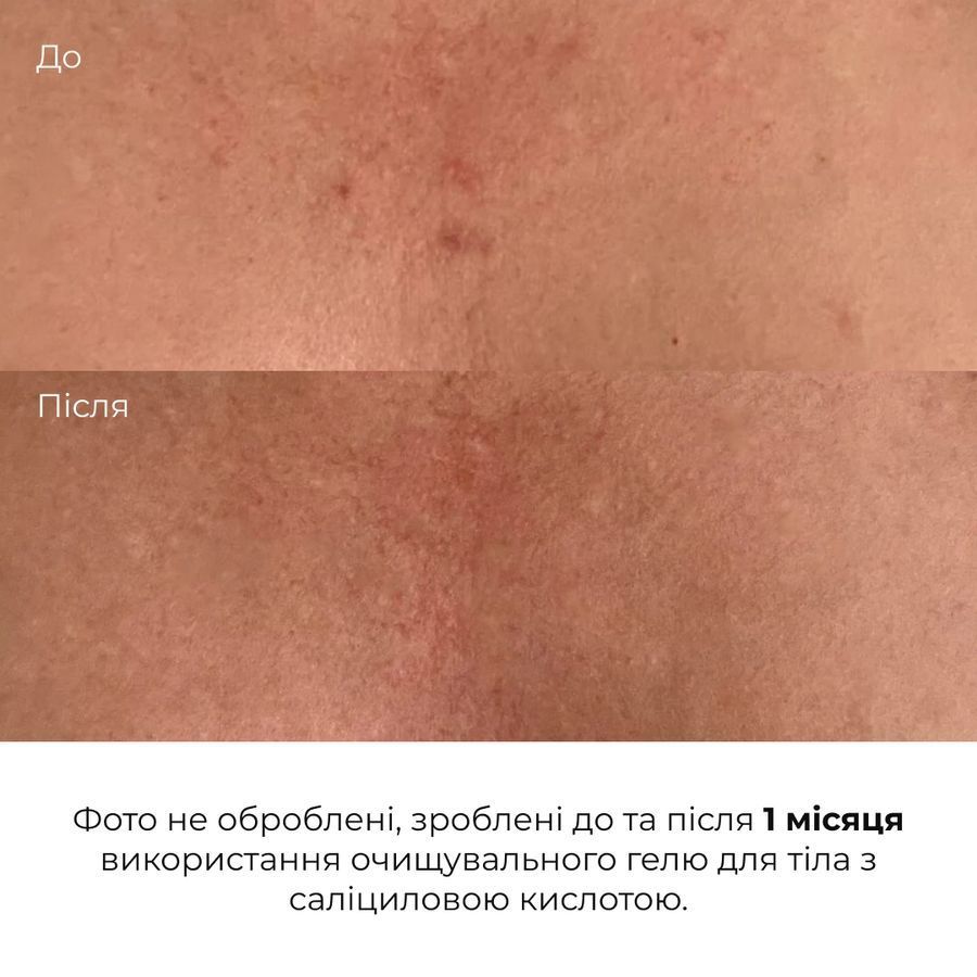 Очищувальний гель для тіла з саліциловою кислотою Hillary Anti-Acne Salicylic Body Wash, 200 мл - фото №1