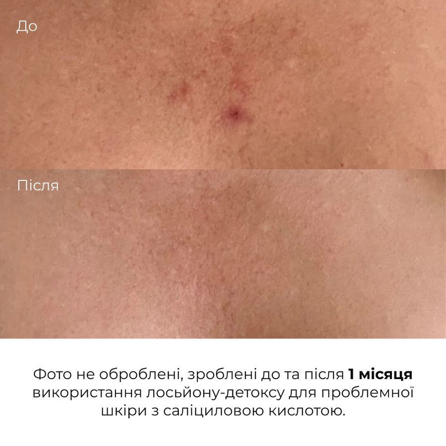 Лосьйон-детокс для проблемної шкіри з саліциловою кислотою Hillary Anti-Acne Salicylic Body Lotion, 150 мл - фото №1