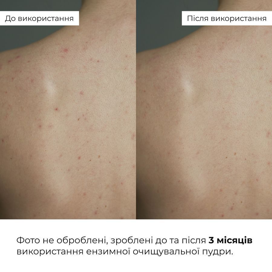 Hillary Enzyme Balance Cleanser Powder + Toner for oily and problematic skin