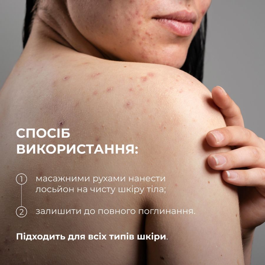 Комплекс для тіла проти акне з саліциловою кислотою Hillary Anti-Acne Body Care Complex with Salicylic Acid - фото №1