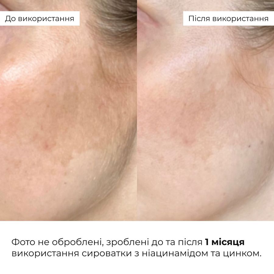 Мультисироватка з ніацинамідом та цинком Hillary Multi Niacinamid serum, 30 мл - фото №1