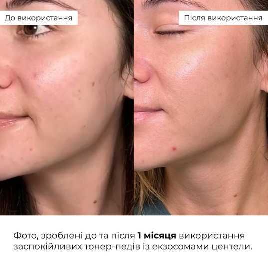 Набір для корекції темних кіл та подразнень Hillary Dark Circles