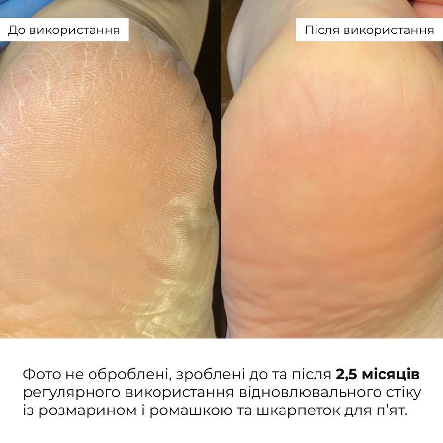 Набір для потрісканих п&rsquo;ят із розмарином та ромашкою Hillary HydraHeel Repair & Comfort Set - фото №1
