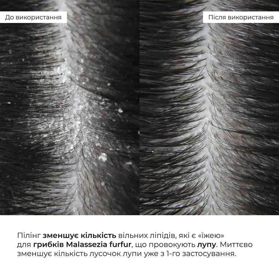 Ензимний трихологічний пілінг для шкіри голови Hillary Enzyme Trichological Scalp Peel, 120 мл - фото №1