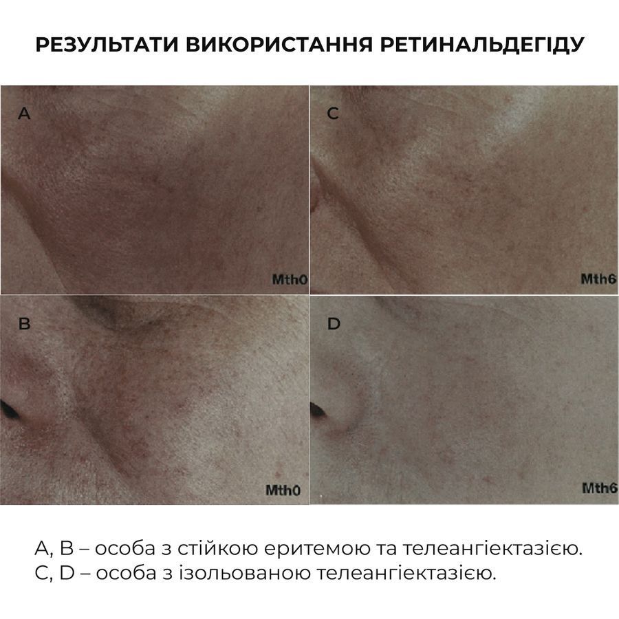 Комплекс антивозрастного ухода с ретиналем для обновления и поддержания упругости кожи HiLLARY - фото №1