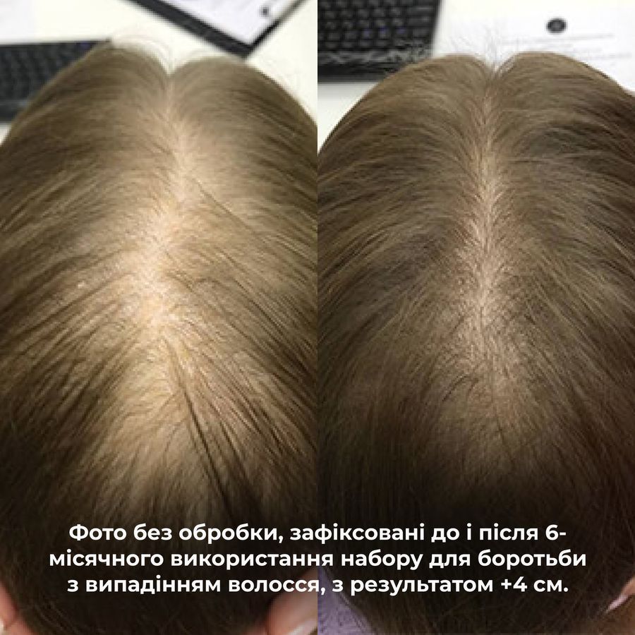 Шампунь проти випадіння волосся Hillary Serenoa & РР Hair Loss Control Shampoo, 250 мл - фото №1