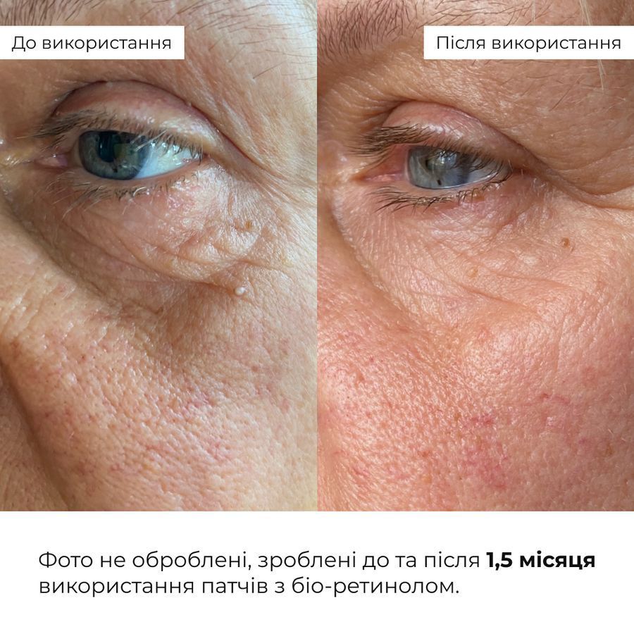Набір для зменшення зморшок і темних кіл навколо очей Hillary Wrinkle & Dark Circle Correction Set - фото №1