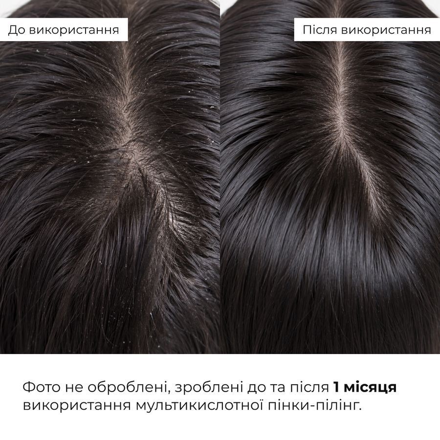 Набір для об&rsquo;єму волосся та себорегуляції шкіри голови Hillary Hair Volume & Scalp Sebum Control Set - фото №1