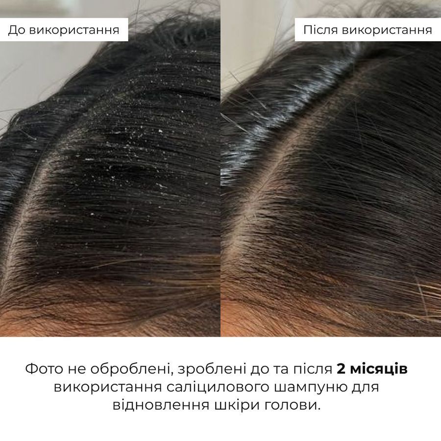 Комплекс для глибокого очищення та оновлення шкіри голови Hillary Deep Scalp Cleansing & Renewal Complex - фото №1