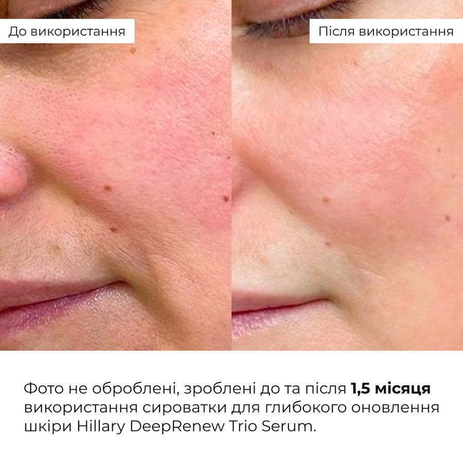 Комплекс базового догляду для оновлення та захисту шкіри Hillary Basic Care Skin Renewal & Protection Set - фото №1